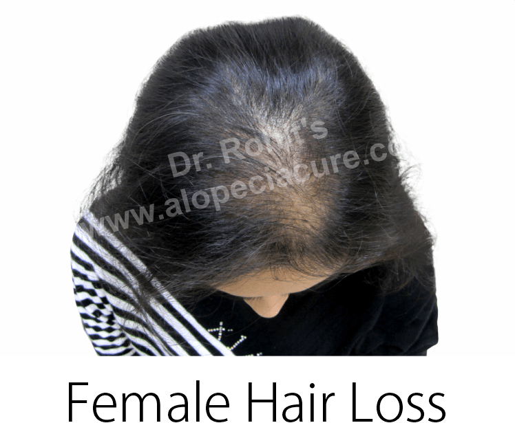 female hair loss